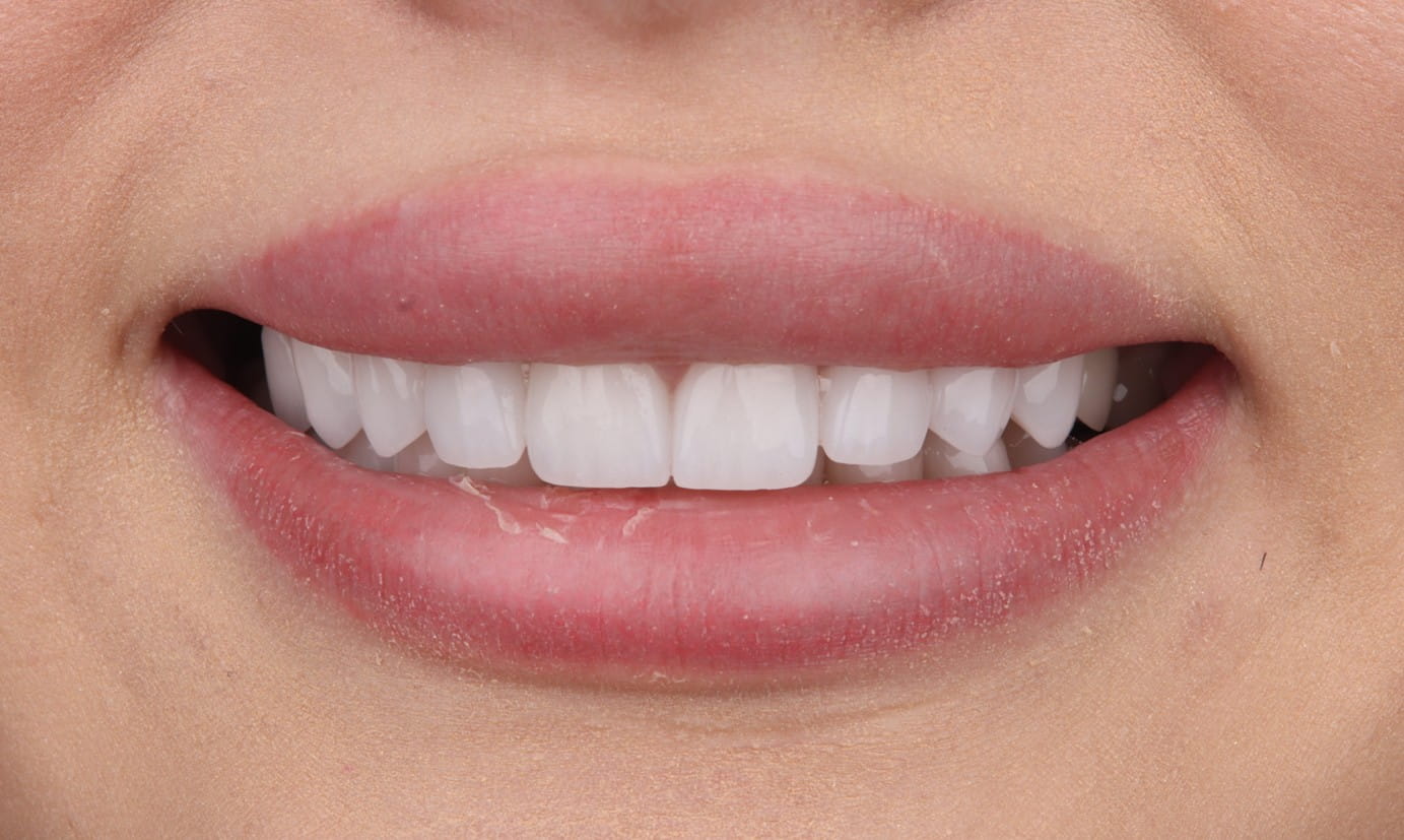 Veneers