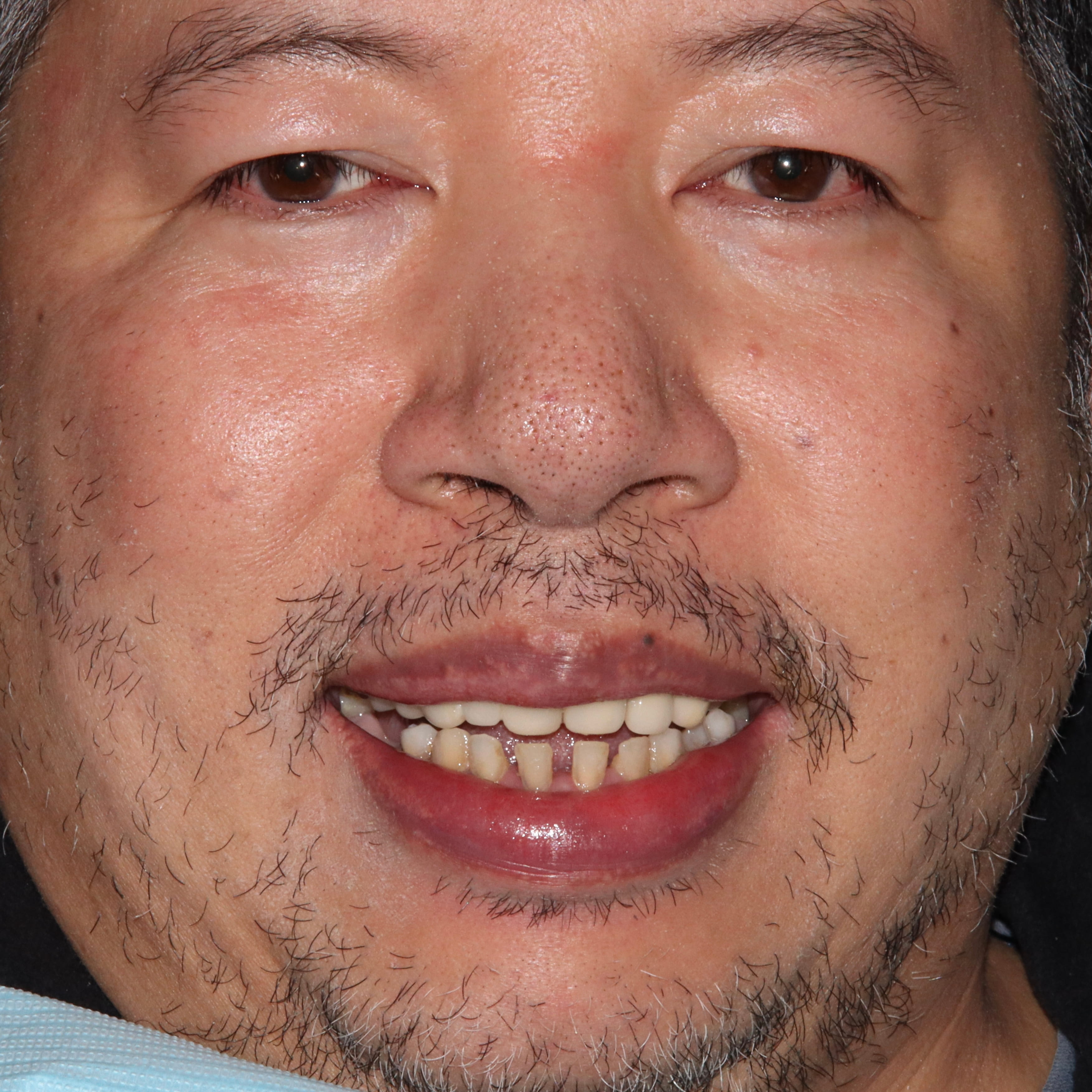Before