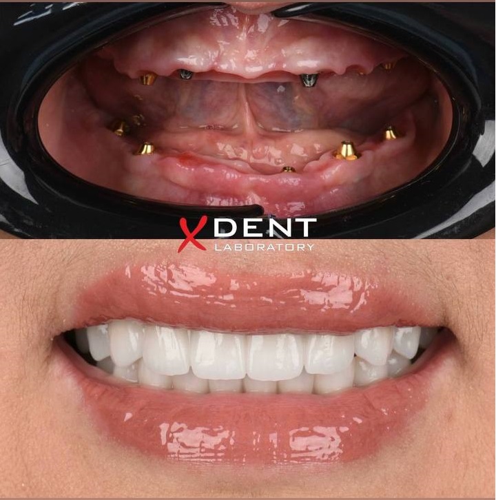 Dental Implants