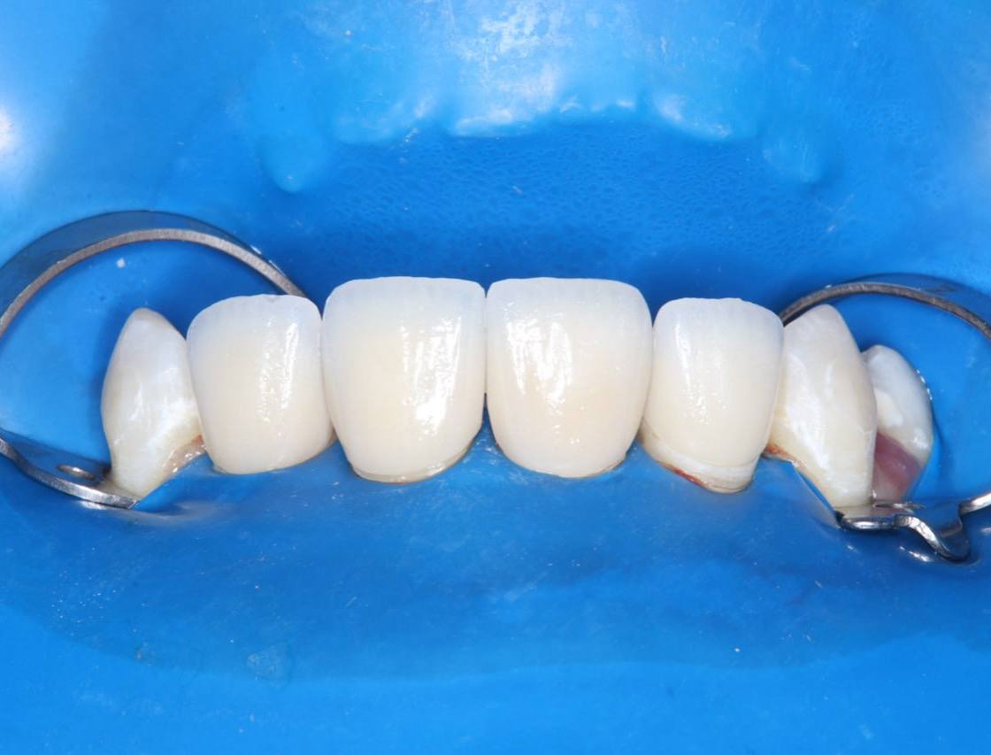 Zirconia Crowns